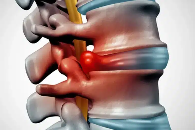 portada rotura protusion hernia discal - Diferencias entre rotura, protusión y hernia discal