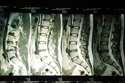 recidiva hernia discal imagen de resonancia