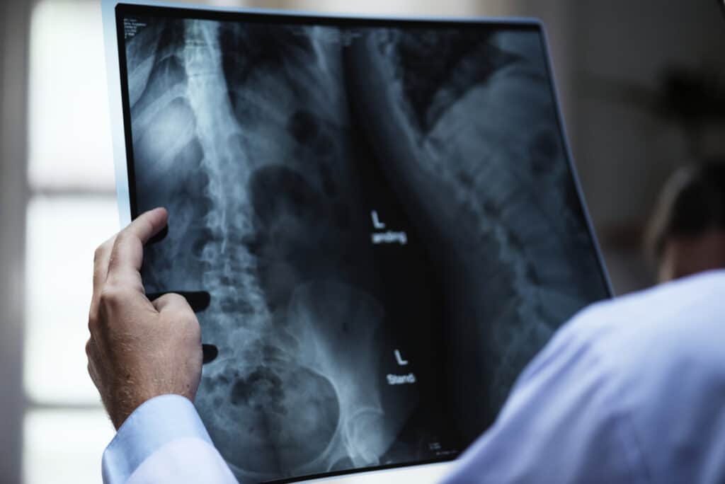 Escoliosis en adultos