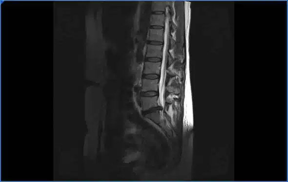 por que las hernias de disco se curan solas 1573908198 1574010922 - ¿Por qué algunas hernias de disco desaparecen por sí solas?