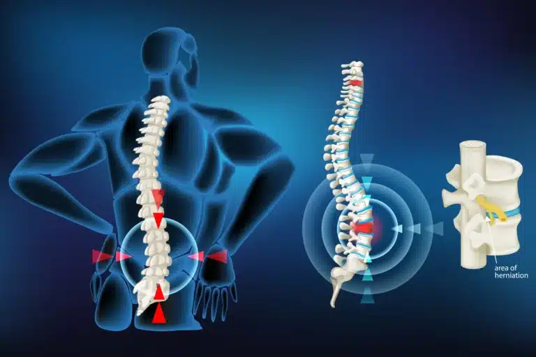 portada hernia l2 l3 - ¿Por qué algunas hernias de disco desaparecen por sí solas?