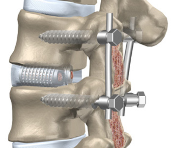 portada impacto fusion vertebral - Artrodesis vertebral. Todo lo que necesitas saber