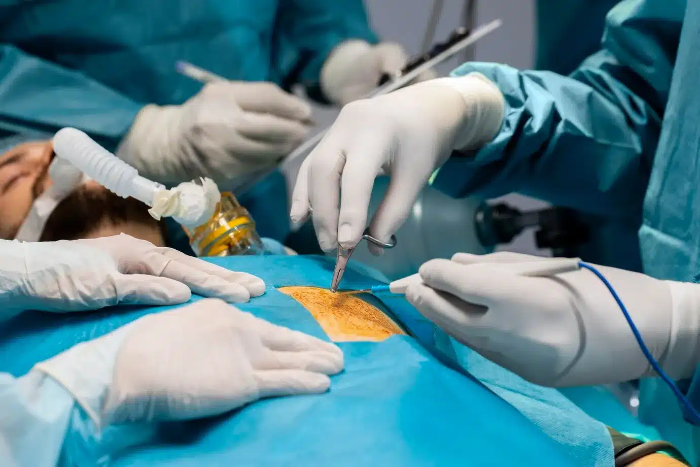Discolisis percutánea con láser