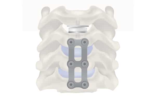 operacion de hernia discal 1568955480 1568956469 - Tipos de cirugía de Hernia Discal.
