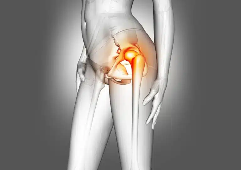 radiculopatia lumbar 11zon - Radiculopatía Lumbar: Causas, Síntomas y Tratamientos