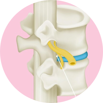 persona con radiculopatía