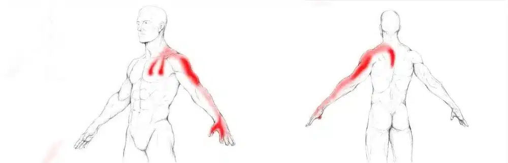 musculos escalenos como afectan al dolor cervical 1604378785 1604380600 11zon - Músculos escalenos. Cómo afectan al dolor cervical.