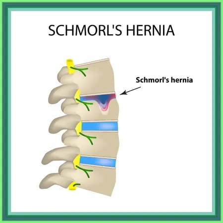 hernia de schmorl 1610947298 1610947811 11zon - ¿Qué es una hernia de Schmorl? Causas, síntomas y tratamiento