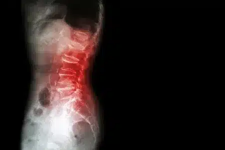 hernia de schmorl 1610947298 1610947827 11zon - ¿Qué es una hernia de Schmorl? Causas, síntomas y tratamiento