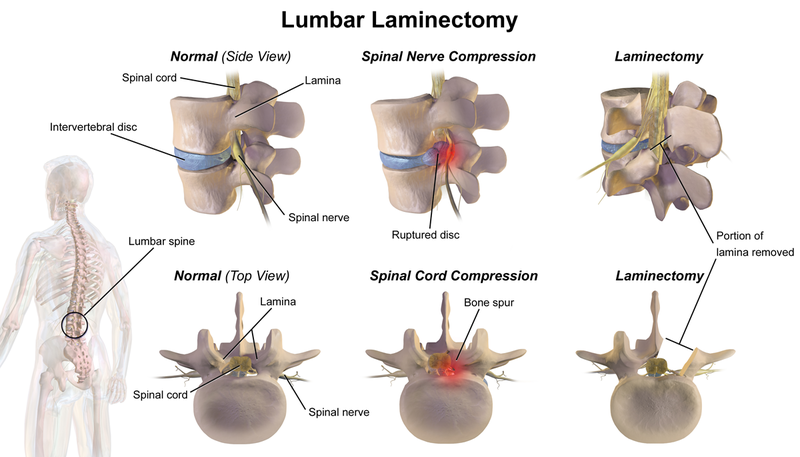 lumbar laminectomy - Operación de cervicales