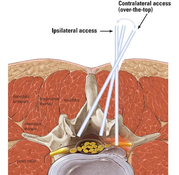 Endoscopia de Columna Interlaminar