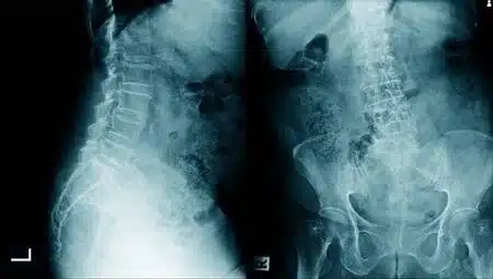 espondilosis 1606108681 - Espondilosis. Que es, porque se produce y como puedes prevenir y tratar sus síntomas.
