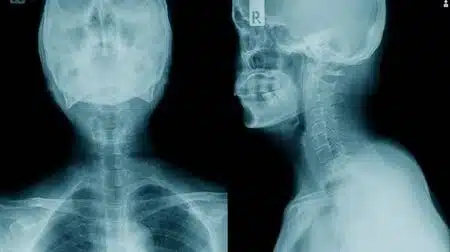 espondilosis 1606108708 - Espondilosis. Que es, porque se produce y como puedes prevenir y tratar sus síntomas.