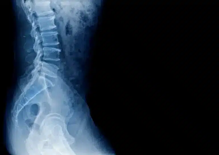 portada espondilosis min.1606107393 11zon - Espondilosis. Que es, porque se produce y como puedes prevenir y tratar sus síntomas.
