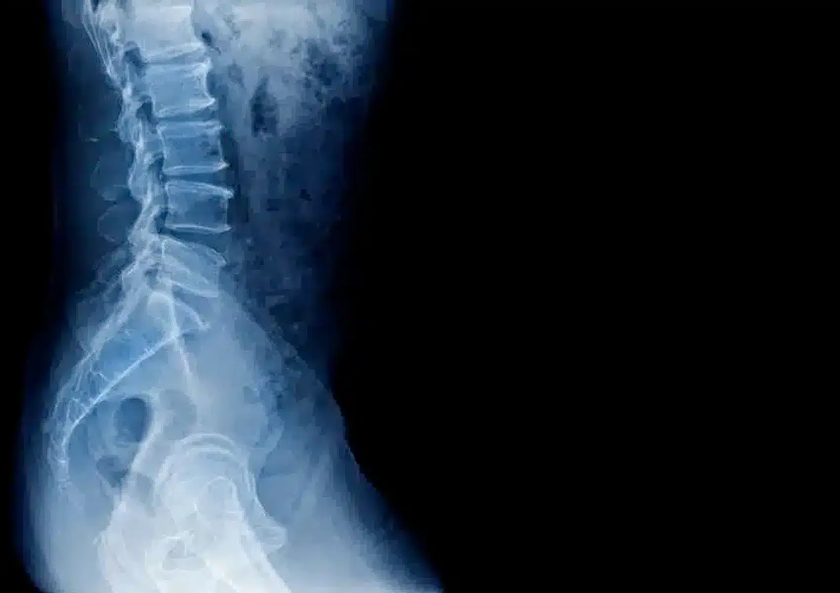 portada espondilosis min.1606107393 11zon - Espondilosis. Que es, porque se produce y como puedes prevenir y tratar sus síntomas.