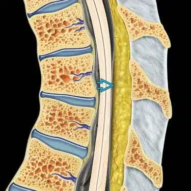 lipomatosis epidural 1645074261 1645074472 - ¿Qué es la Lipomatosis epidural? Causas, Síntomas y Tratamiento