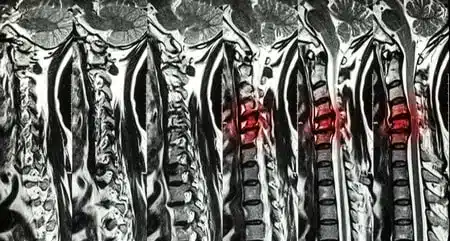 sintomas de hernia grave cuando acudir a tu medico 1647494109 1647494371 - Sintomas de hernia discal graves. Cuando debes  acudir a tu médico.