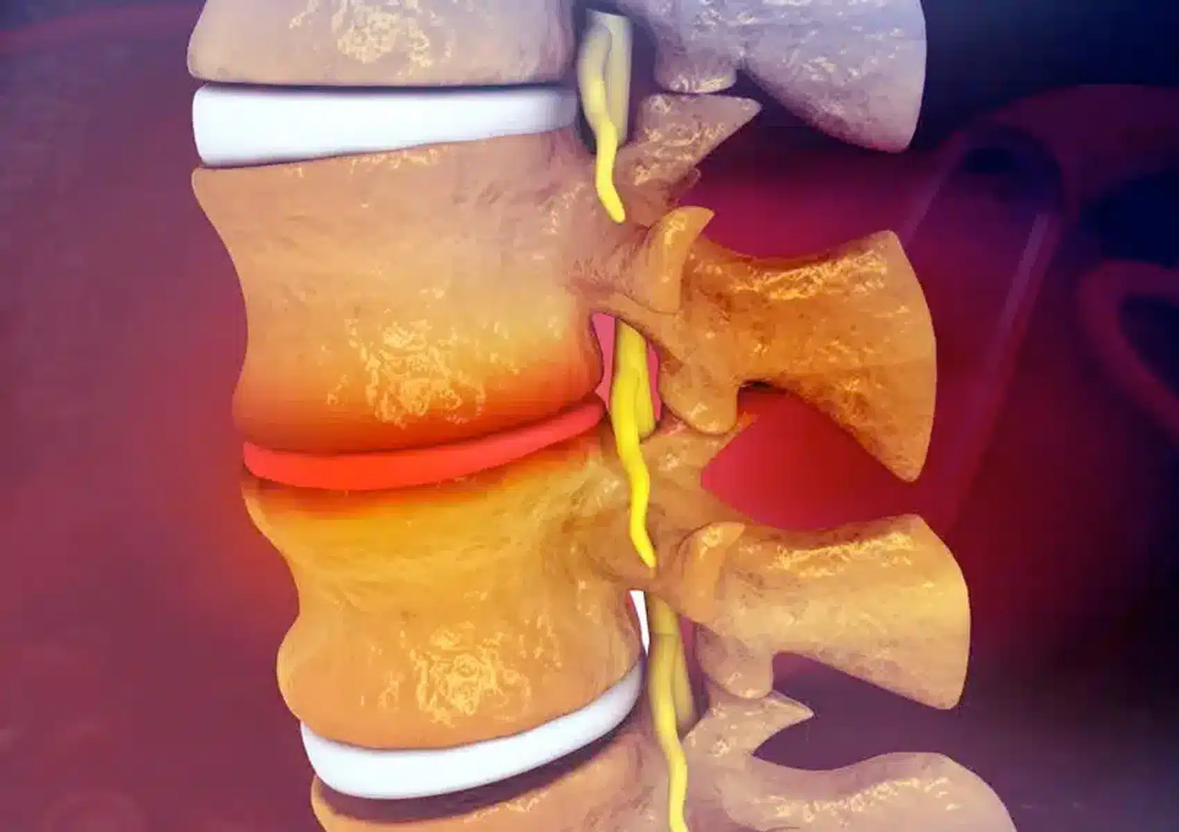 hernia discal dorsal toracica.1662653253 11zon - Todo lo que necesitas saber sobre las hernias dorsales o torácicas