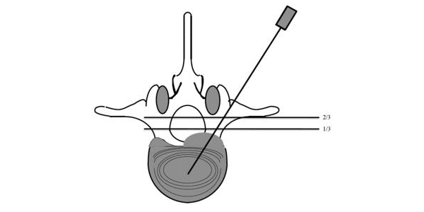 hernia discal l4 l5 sintomas diagnostico y tratamiento 1567095482 1568574443 - HERNIA DISCAL L4-L5. Síntomas, diagnóstico y tratamiento