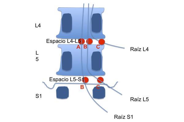 hernia discal l4 l5 sintomas diagnostico y tratamiento 1567095482 1568606429 - HERNIA DISCAL L4-L5. Síntomas, diagnóstico y tratamiento