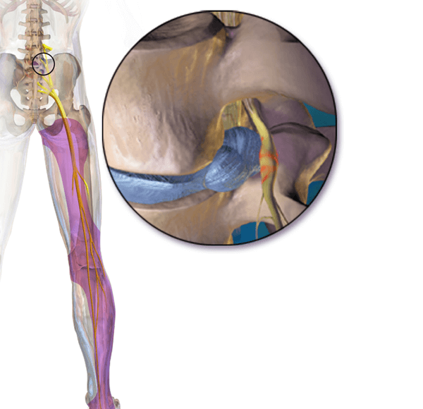 hernia discal l5 s1 1542565157 - Hernia Discal L5-S1. Diagnóstico, Síntomas y Tratamiento.