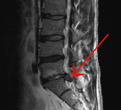 hernia discal l5 s1 1542565198 - Hernia Discal L5-S1. Diagnóstico, Síntomas y Tratamiento.