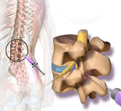 hernia-discal-l5-s1-diagnostico-sintomas-y-tratamiento-1543211415-1543211862