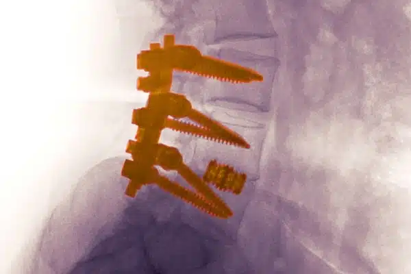 Artrodesis fusion vertebral - Artrodesis vertebral ¿qué es y cuándo se hace?