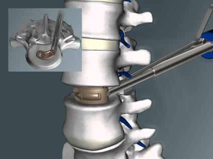 cajas intersomaticas 1570423251 1574659035 - Artrodesis vertebral ¿qué es y cuándo se hace?
