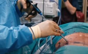 endoscopia de columna 1632196945 - Medicación para la ciática