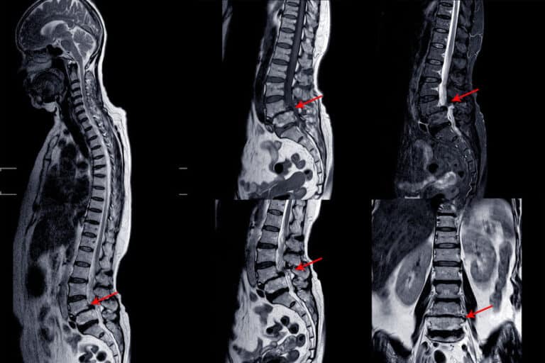 estenosis de canal portada.1636521075 - ¿Qué es la estenosis de canal lumbar?