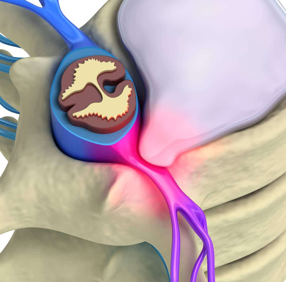 foto hernia 1.1508187087 - Todo lo que necesitas saber sobre una discectomía/microdiscectomía