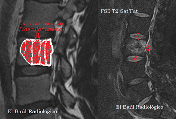 hemangioma 3 3.1556981498 - Hemangiomas vertebrales.