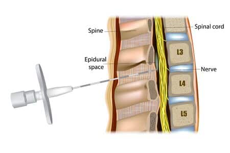 Infiltración epidural