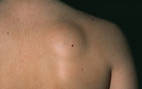 lipoma portada min.1588828173 - Bultos de grasa en la espalda.