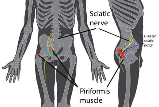 piriformis syndrome.1512484872 -  Síndrome del músculo piramidal