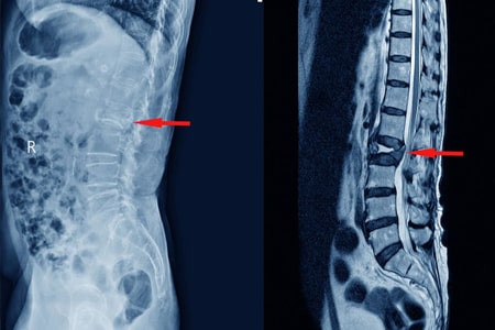 portada aplastamiento vertebral.1634098486 - ¿Qué es un aplastamiento vertebral? Causas, síntomas y tratamiento