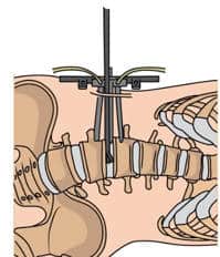 portada olif min.1583063645 - OLIF. Técnica minimamente invasiva para realizar fusiones vertebrales.