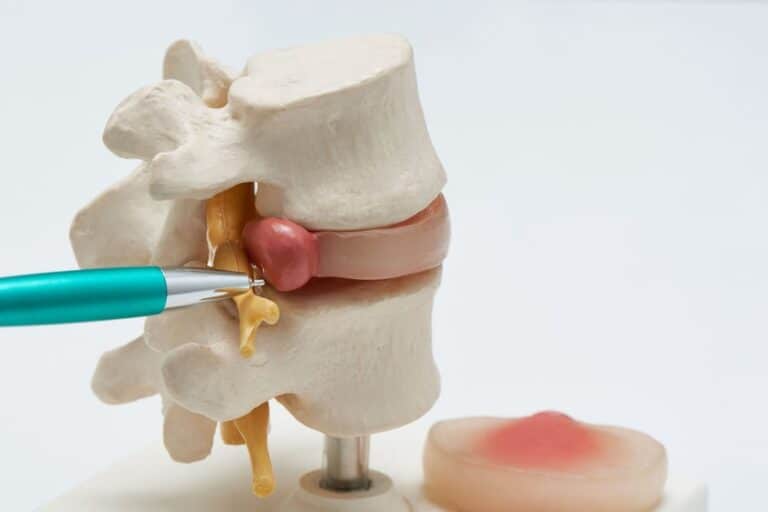 portada tipos d ehernia discal min.1592984373 - Características y tipos de hernia discal ¡Conócelas!