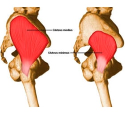 Síndrome del Glúteo Medio