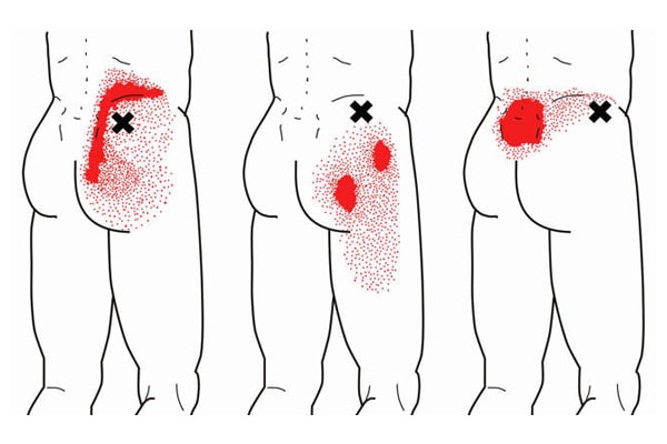 pseudociatica ii sindrome del gluteo medio 1512998091 1512998744 -  Sindrome del músculo gluteo medio