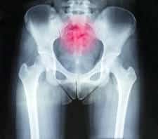 radiografia dolor de - DOLOR DE CÓCCIX. Causas, diagnóstico y tratamiento