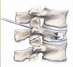vertebroplastia - ¿Qué es un aplastamiento vertebral? Causas, síntomas y tratamiento