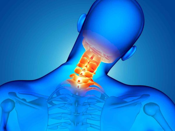 Artrosis cervical