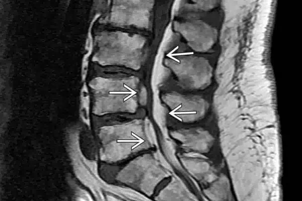 lipomatosis-epidural-1645074261-1645074508-1