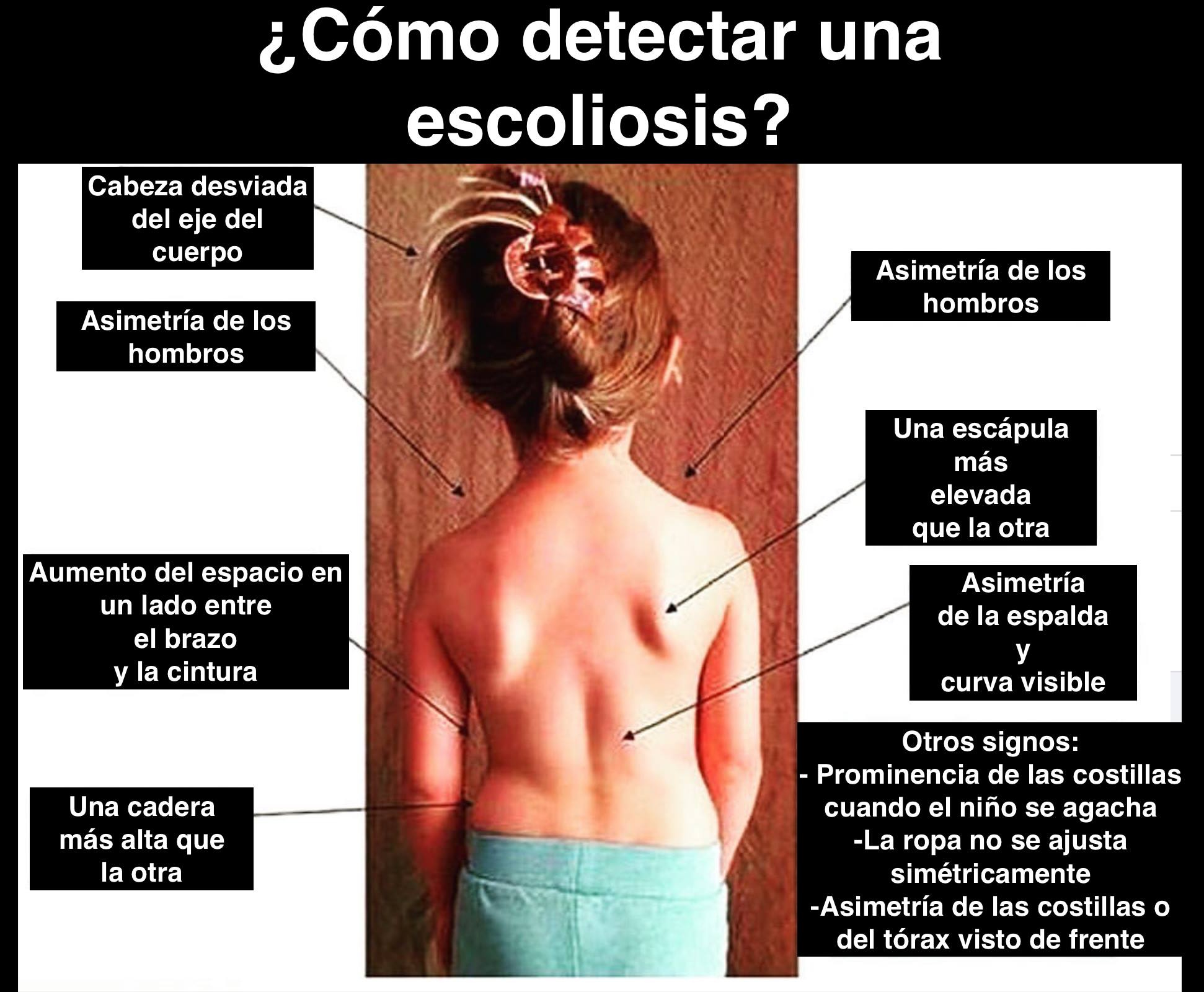 Cómo detectar la escoliosis