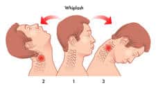 Latigazo cervical, origen del vértigo cervical