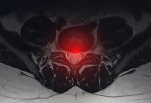 Herniated disc origin