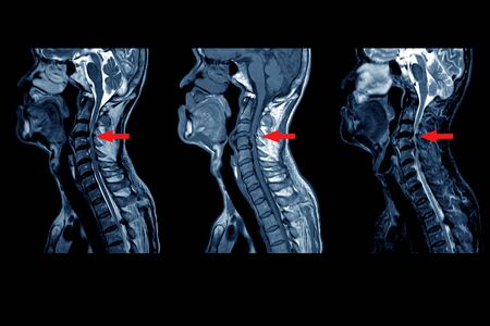 Artrodesis Cervical