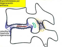 espondilolistesis degnerativa